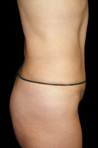 Tummy Tuck Before & After Patient #3293