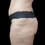 Tummy Tuck Before & After Patient #3312
