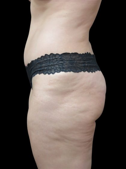 Tummy Tuck Before & After Patient #3312