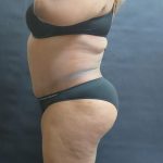 Tummy Tuck Before & After Patient #3333