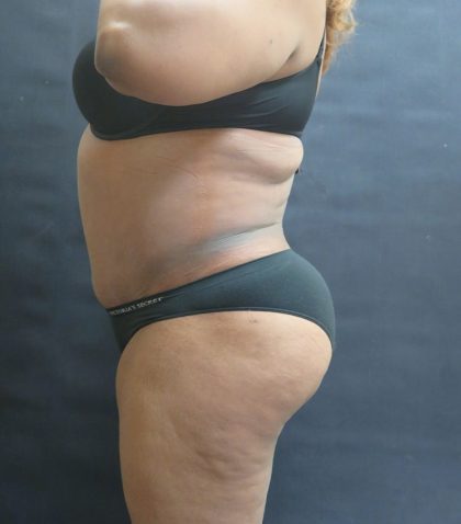 Tummy Tuck Before & After Patient #3333