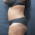 Tummy Tuck Before & After Patient #3380