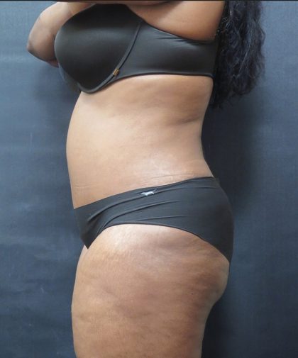 Tummy Tuck Before & After Patient #3380