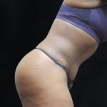 Tummy Tuck Before & After Patient #3387