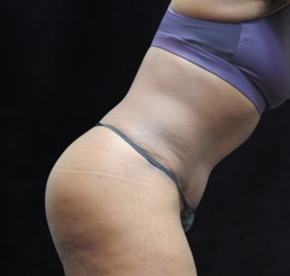 Tummy Tuck Before & After Patient #3387