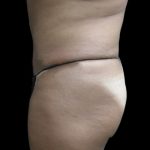 Tummy Tuck Before & After Patient #3403