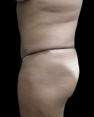 Tummy Tuck Before & After Patient #3403