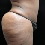 Tummy Tuck Before & After Patient #3412