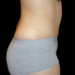 Tummy Tuck Before & After Patient #3426