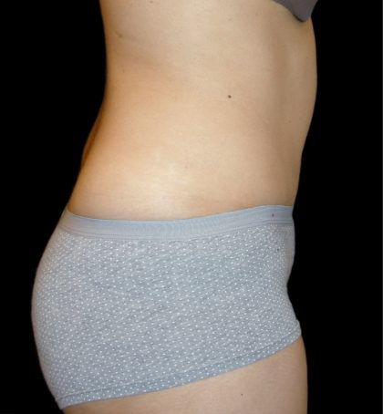Tummy Tuck Before & After Patient #3426