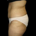 Tummy Tuck Before & After Patient #3433