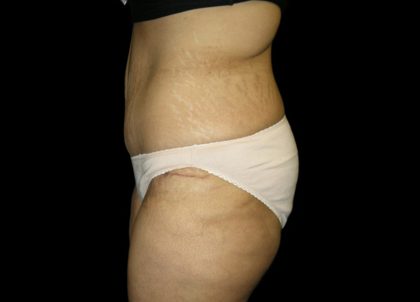 Tummy Tuck Before & After Patient #3433