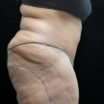 Tummy Tuck Before & After Patient #3352