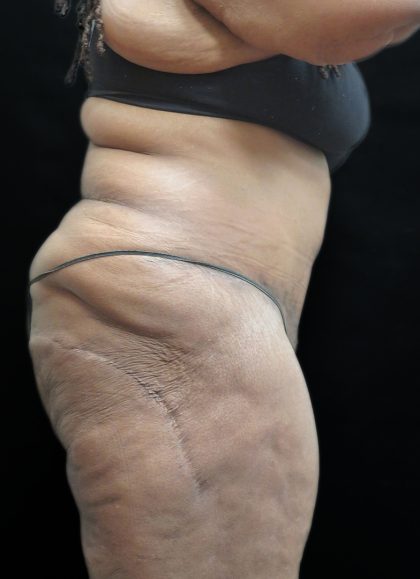 Tummy Tuck Before & After Patient #3352