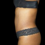 Mommy Makeover Before & After Patient #2442