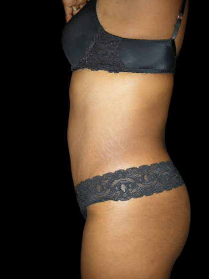 Mommy Makeover Before & After Patient #2442