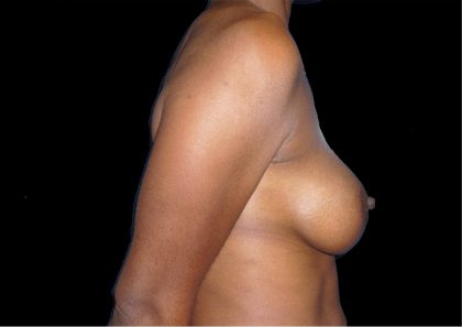 Breast Augmentation Before & After Patient #1098