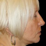 Browlift Before & After Patient #1461