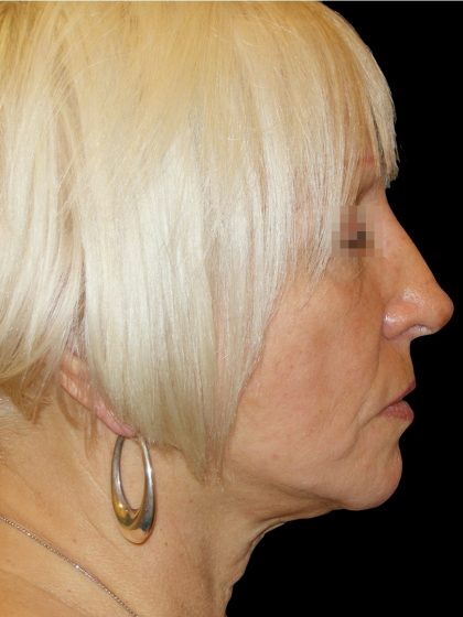 Browlift Before & After Patient #1461