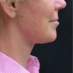 Levinelift Before & After Patient #1999