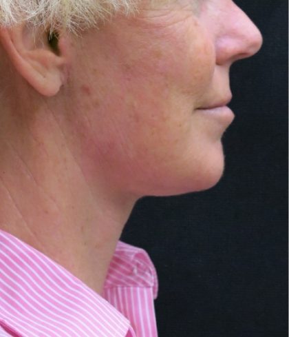 Levinelift Before & After Patient #1999