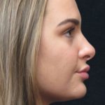 Rhinoplasty Before & After Patient #2926
