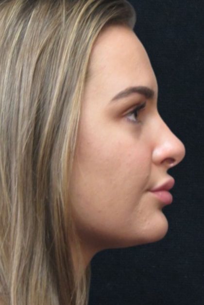 Rhinoplasty Before & After Patient #2926