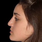 Rhinoplasty Before & After Patient #2919