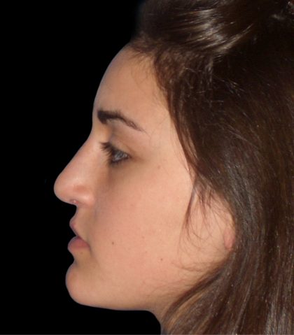 Rhinoplasty Before & After Patient #2919