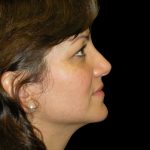 Rhinoplasty Before & After Patient #2805