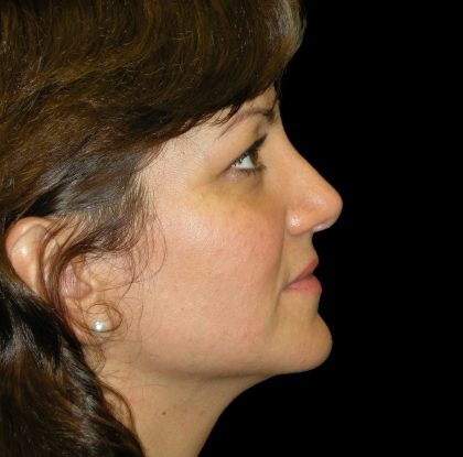 Rhinoplasty Before & After Patient #2805