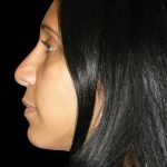 Rhinoplasty Before & After Patient #2912
