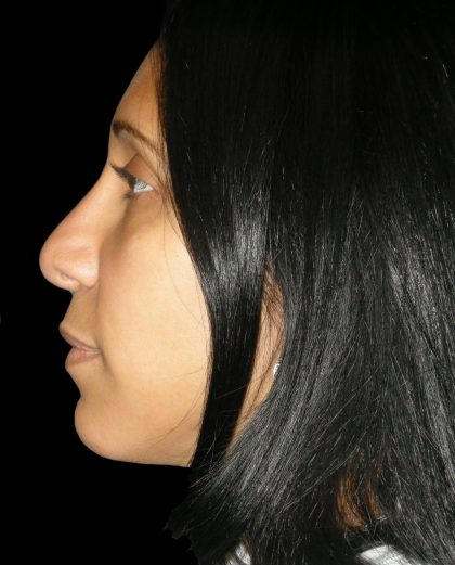 Rhinoplasty Before & After Patient #2912