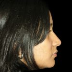 Rhinoplasty Before & After Patient #2905