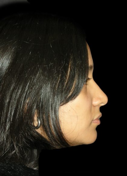 Rhinoplasty Before & After Patient #2905