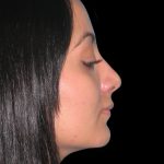Rhinoplasty Before & After Patient #2819
