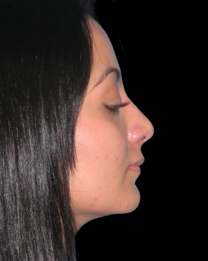 Rhinoplasty Before & After Patient #2819