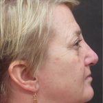 Rhinoplasty Before & After Patient #2826