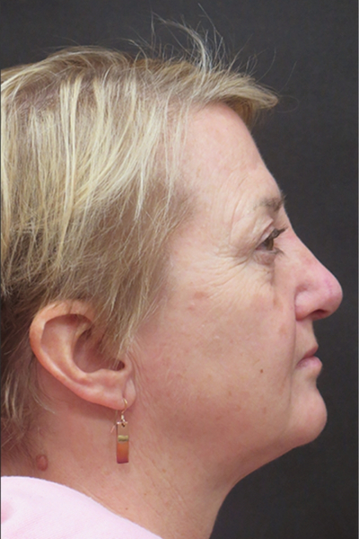 Rhinoplasty Before & After Patient #2826