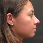 Rhinoplasty Before & After Patient #2798