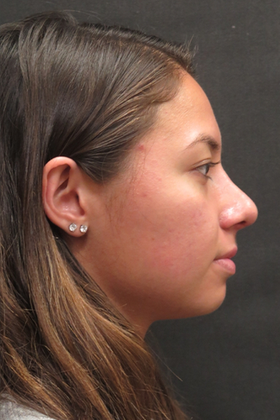 Rhinoplasty Before & After Patient #2798
