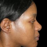 Rhinoplasty Before & After Patient #2812