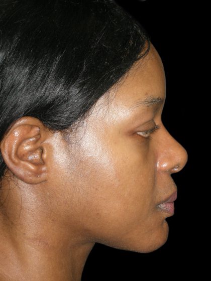Rhinoplasty Before & After Patient #2812