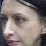 Rhinoplasty Before & After Patient #2877