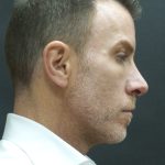 Rhinoplasty Before & After Patient #2870