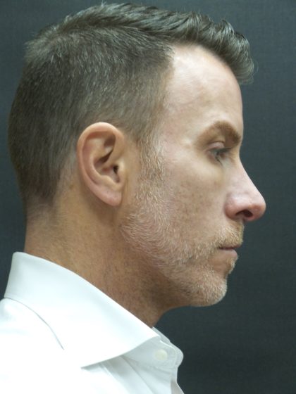 Rhinoplasty Before & After Patient #2870