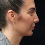 Rhinoplasty Before & After Patient #2851