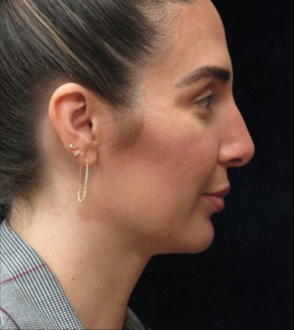 Rhinoplasty Before & After Patient #2851