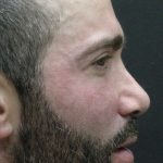 Rhinoplasty Before & After Patient #2884