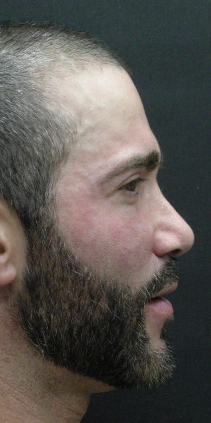 Rhinoplasty Before & After Patient #2884